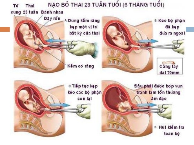 Phá thai bằng phương pháp nong, gắp thai