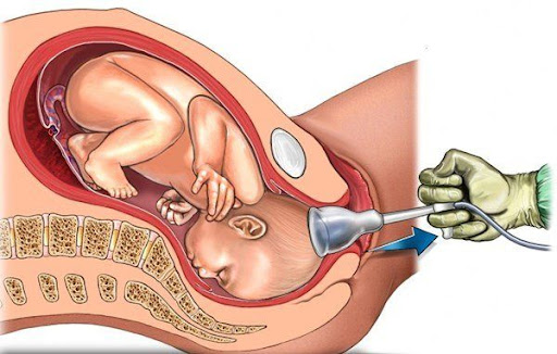 phá thai ngoại khoa